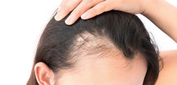 علاجات فراغات الشعر الأمامية